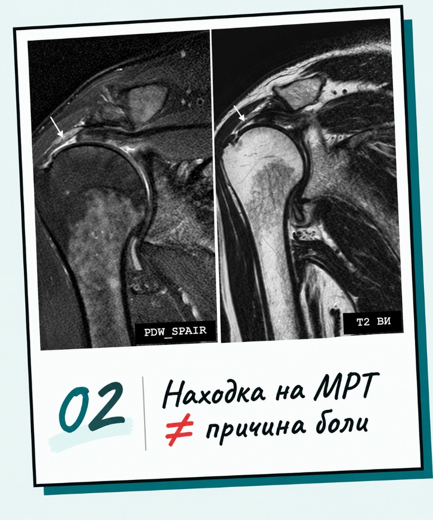 02 Находка на МРТ ≠ причина боли