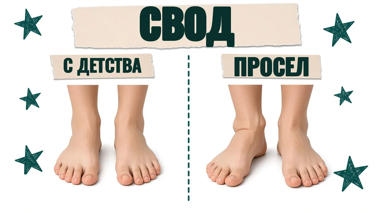Слева обе стопы плоские с детства, справа на одной стопе свод недавно просел
