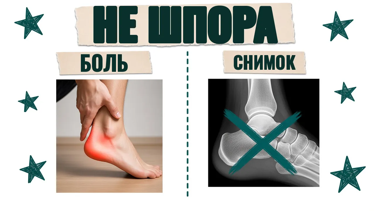 Слева боль в пятке, справа перечёркнутый рентген стопы, надпись «Не шпора»